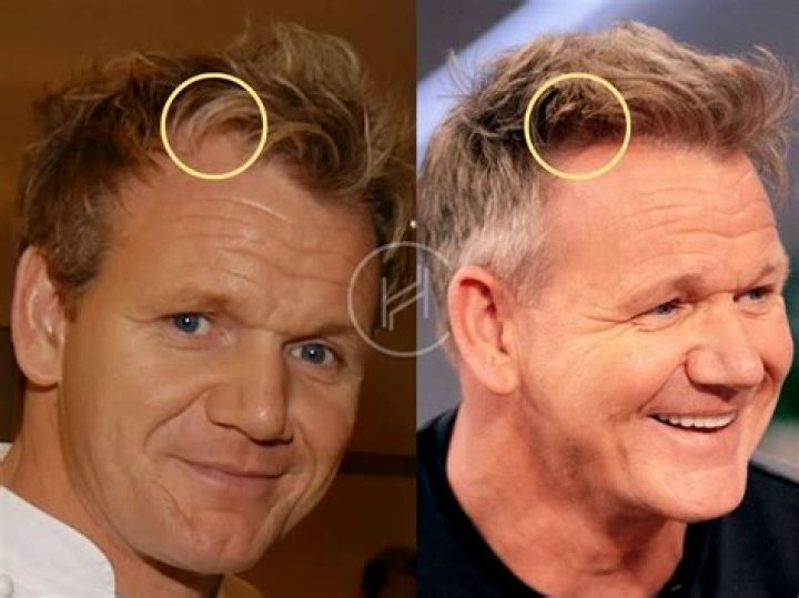Balding Prince Harry: Takes Gordon Ramsay Hair Transplant Plugs Advice So He Won’t Look Like Prince William! (PHOTOS)