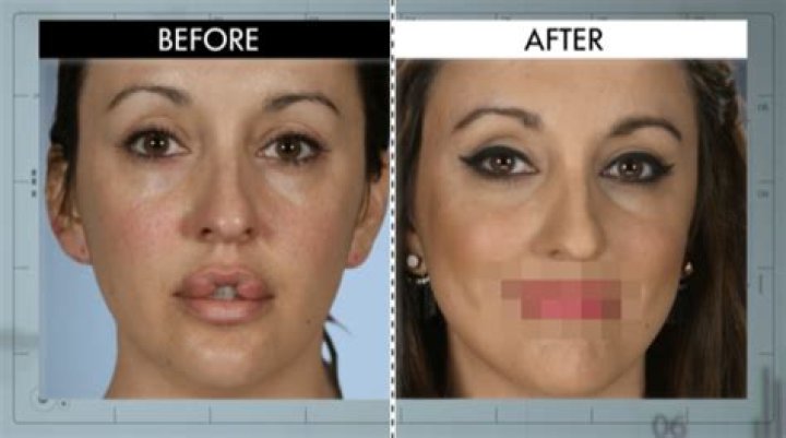 Botched Recap 5/17/16: Season 3 Episode 2 “Man Boobs”