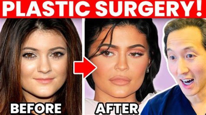 Kylie Jenner Plastic Surgery: 7 Procedures by 17 Years Old, Bigger Butt, Boobs, and Lips – “I’m The Hot One Now”