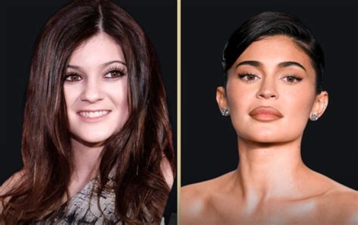 Kylie Jenner Plastic Surgery: 7 Procedures by 17 Years Old, Bigger Butt, Boobs, and Lips - "I'm The Hot One Now"