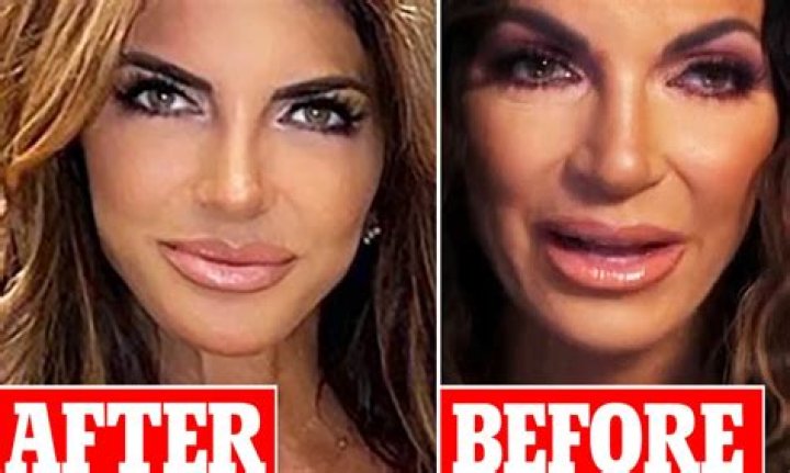 Teresa Giudice Plastic Surgery Shocker: RHONJ Star Won’t Admit To Secrete Hairline Surgery?